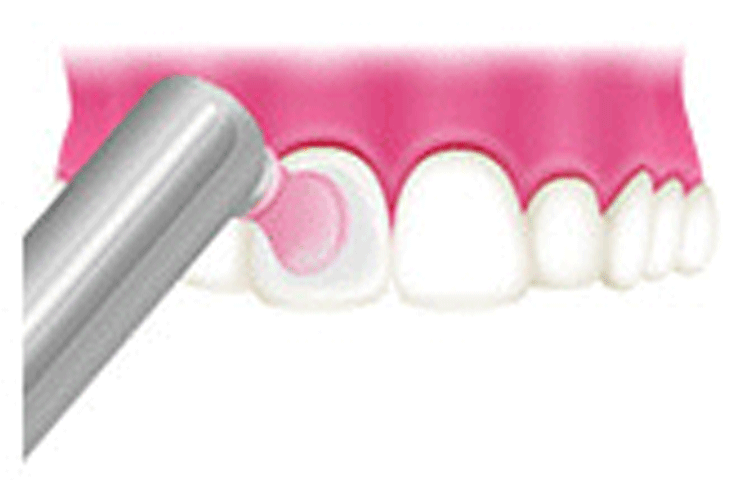 歯石除去・クリーニング